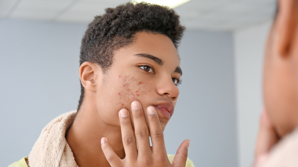 Best Acne Product for Teenage Guys TreeActiv