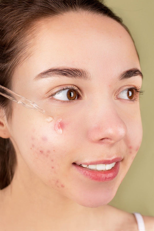 Illustration of Acne Removal Treatments For Teenagers