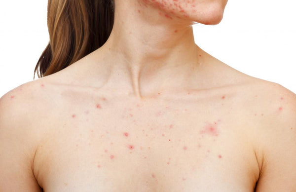 Best Products for Chest Acne