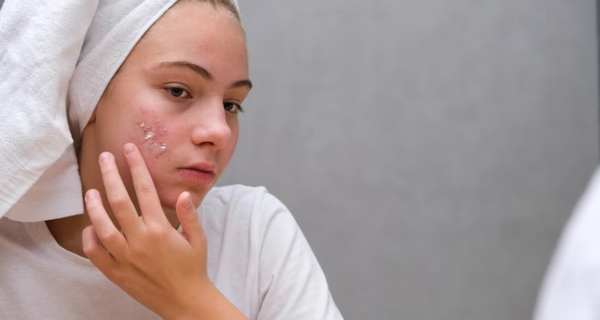The 5 Best Acne Spot Treatments for Swift Pimple Shrinkage