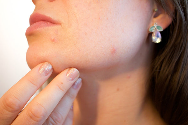 Treating Hormonal Acne From The Inside