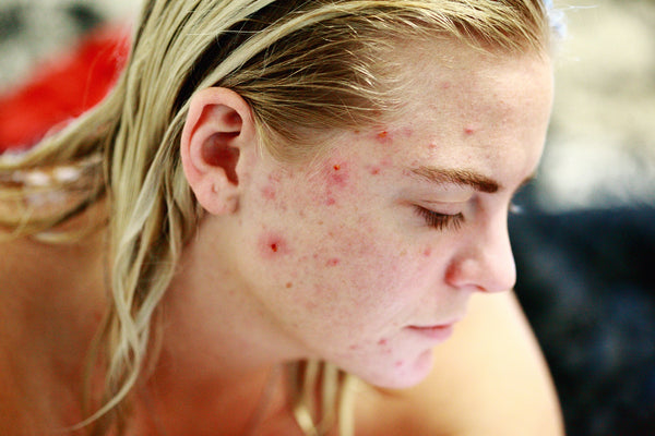 What Your Acne Says About Your Health - TreeActiv