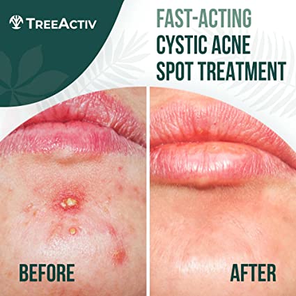 Cystic Acne Spot Treatment