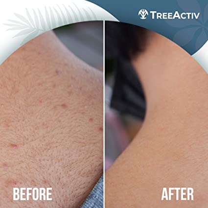 Back Body Acne Kit