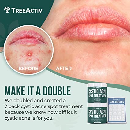 TreeActiv Cystic Acne Spot Treatment | Sulfur 3% & Tea Tree Oil Blemish Remover for Face & Body | Zit, Milia, Severe & Hormonal Acne Treatment for Teens, Adults, Men, & Women | 240+ Treatments, 2-Pack