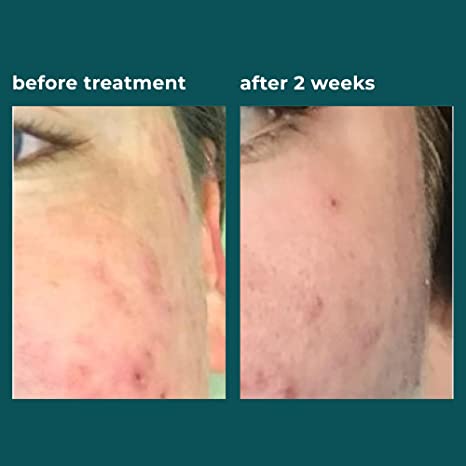 TreeActiv 4-Step Acne Treatment Kit